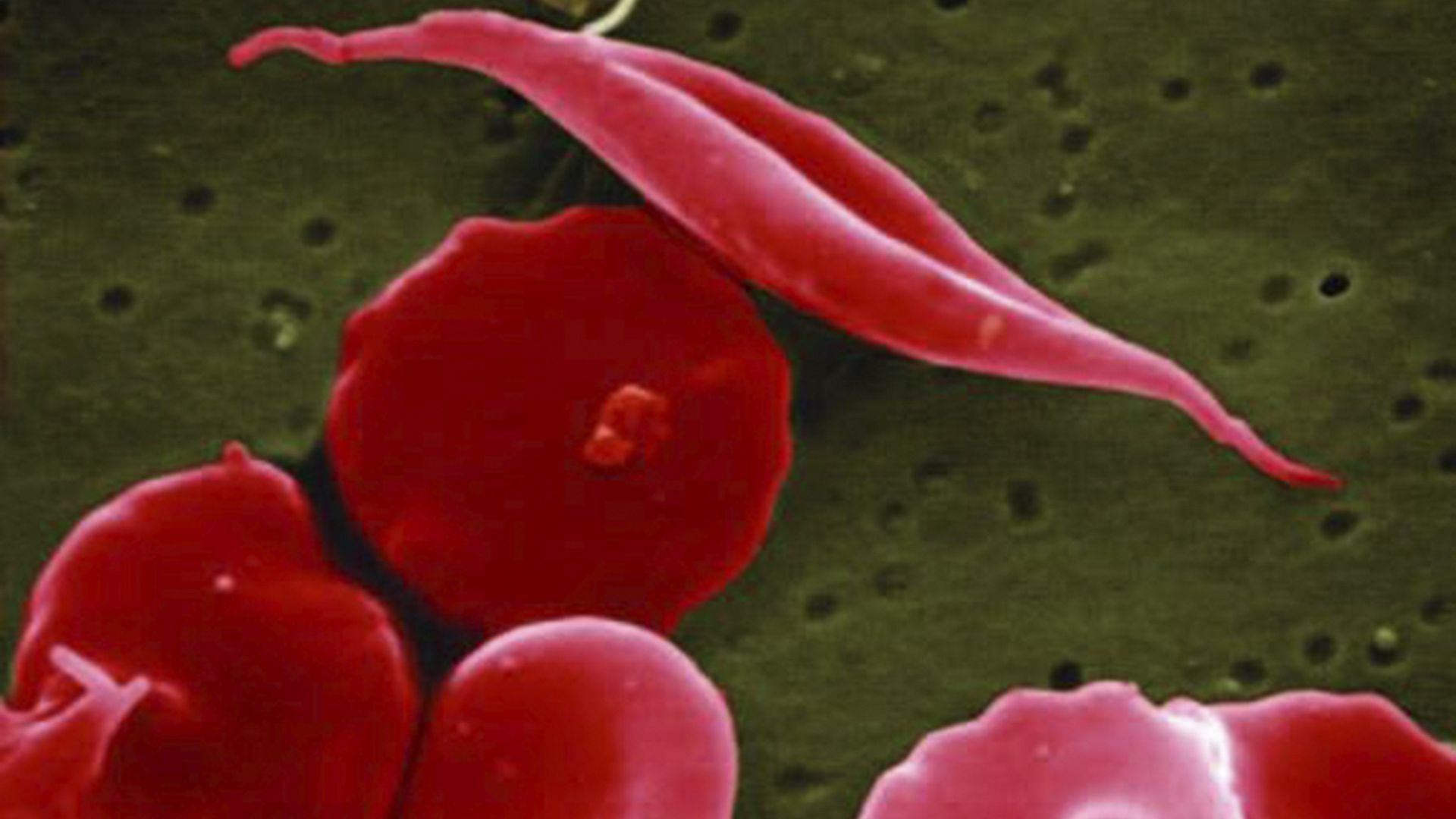 NHS to get access to gene editing therapy for sickle cell disease